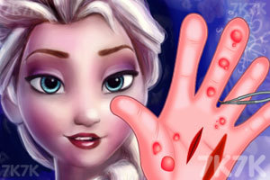 艾莎的手部治疗